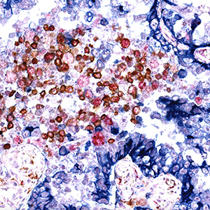 Lung Adenocarcinoma: CD68, CD163, PD-L1.
